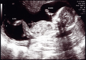 how to determine the gender of the baby in ultrasound